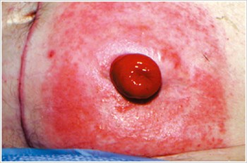 Allergic Contact Dermatitis