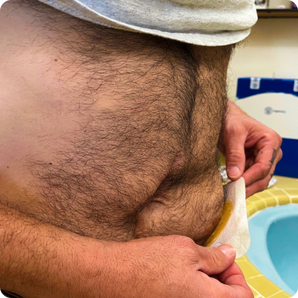 Close-up van een maag met een stoma