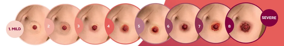 Stages of Peristomal Skin Problems.