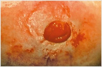 Eine Nahaufnahme der Haut einer Person mit einem roten Kreis