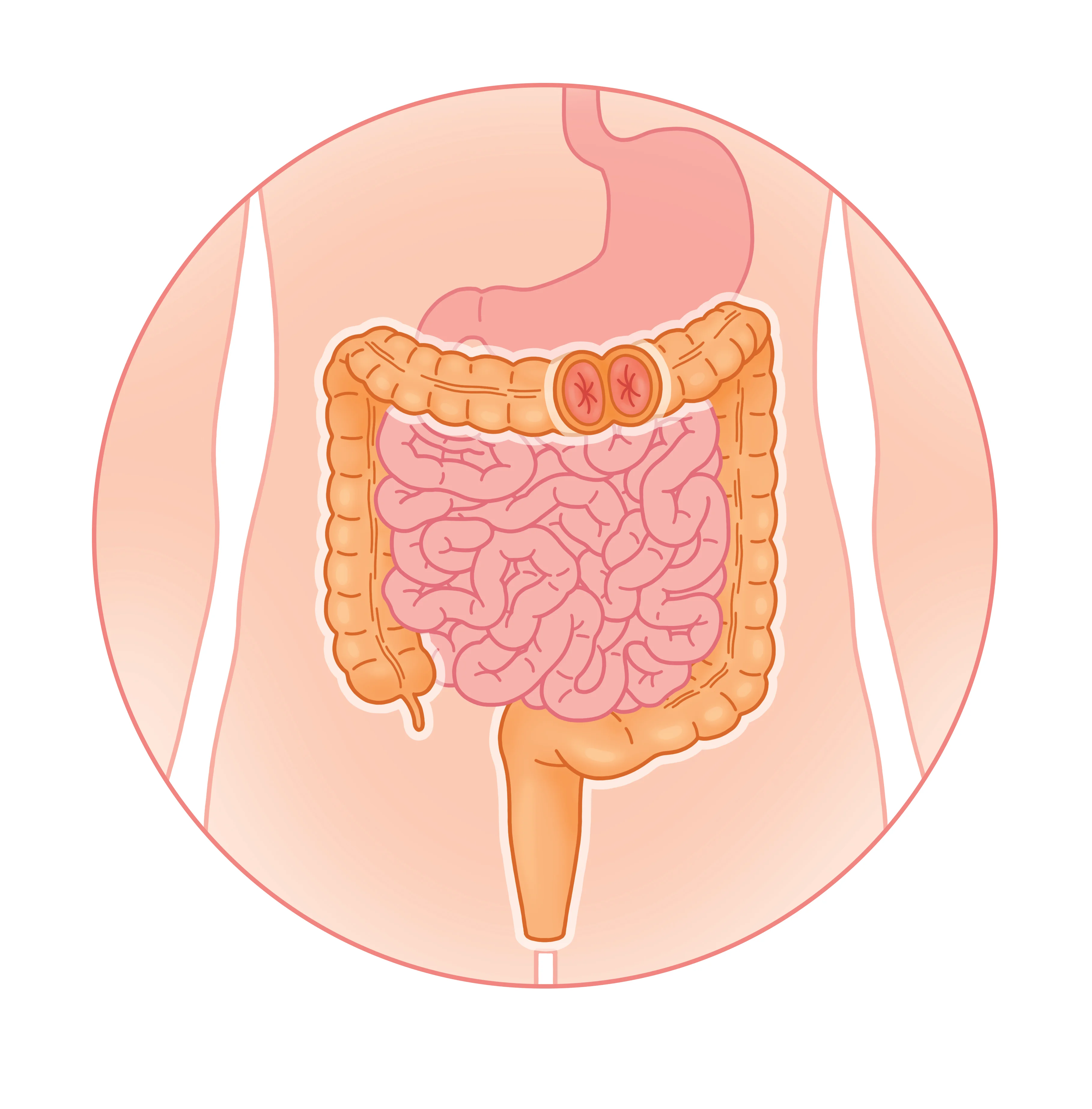 Colostomie transverse