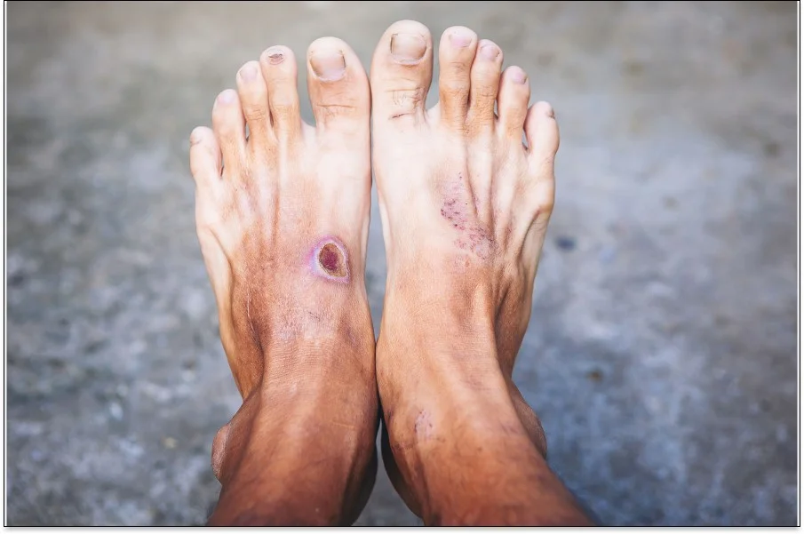 Sicht auf die obere Seite von zwei Füßen mit diabetischer Fußulzera. 