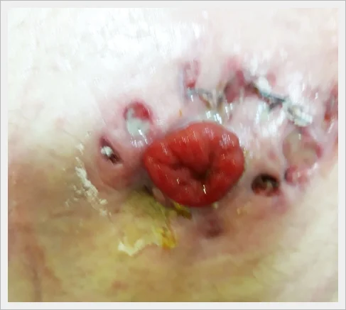 ZAKAŻENIA SK&Oacute;RY - BAKTERYJNE I GRZYBICZE.jpg